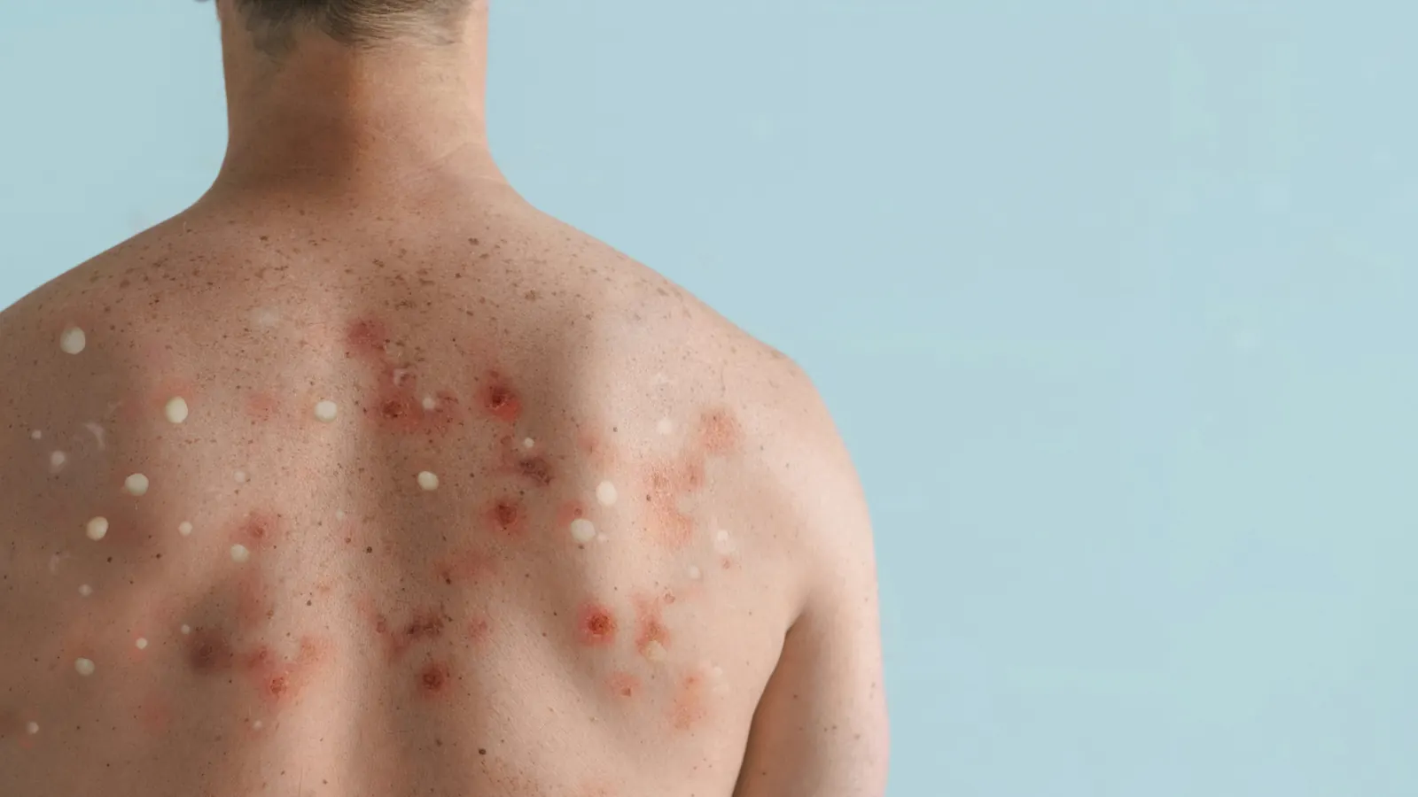 Close-up of a skin rash on a person’s back